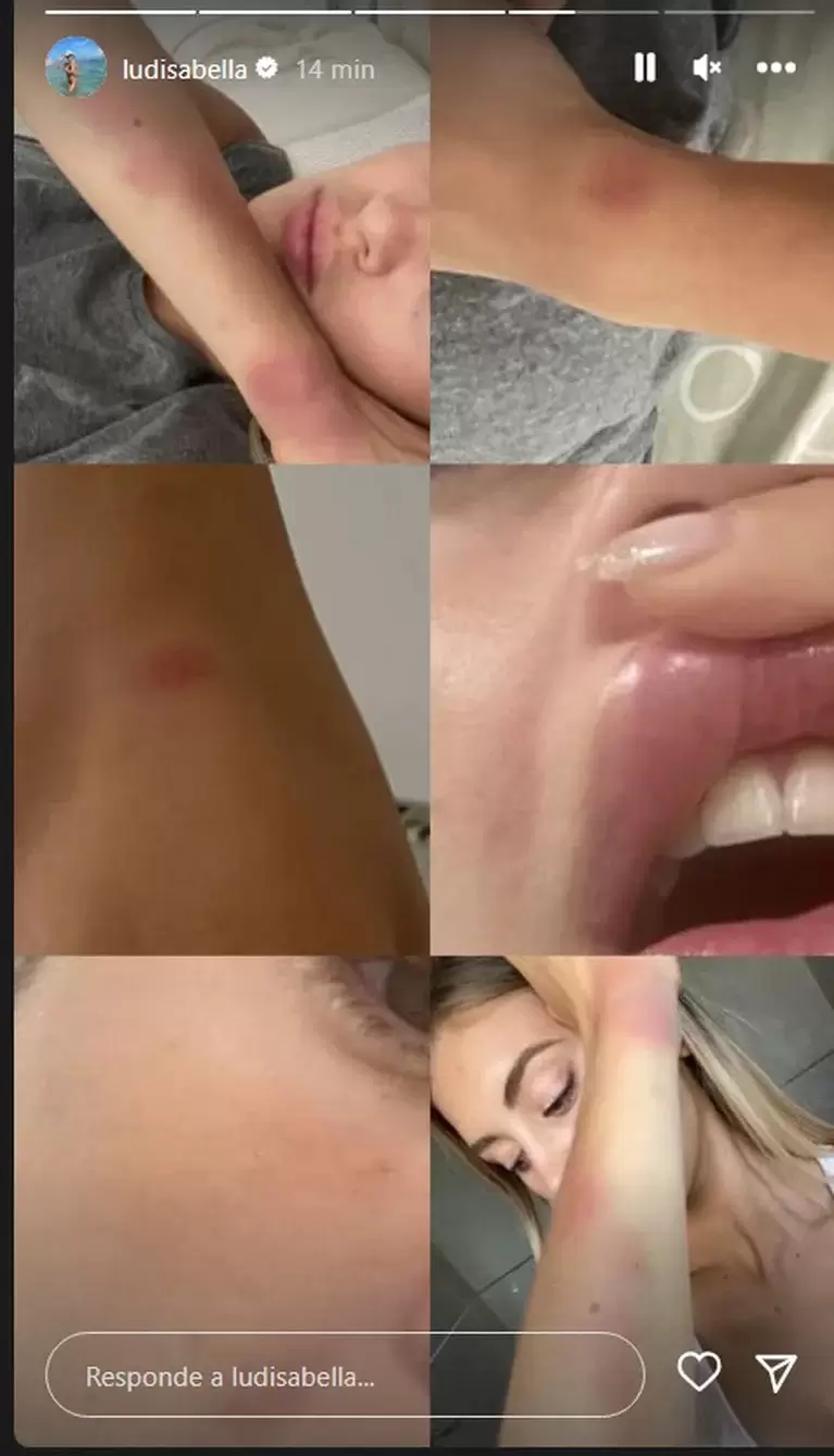La pareja de Lautaro Acosta mostr en redes sociales las cicatrices que le quedaron despus de los golpes de Lautaro Acosta. (Instagram Ludmila Isabel